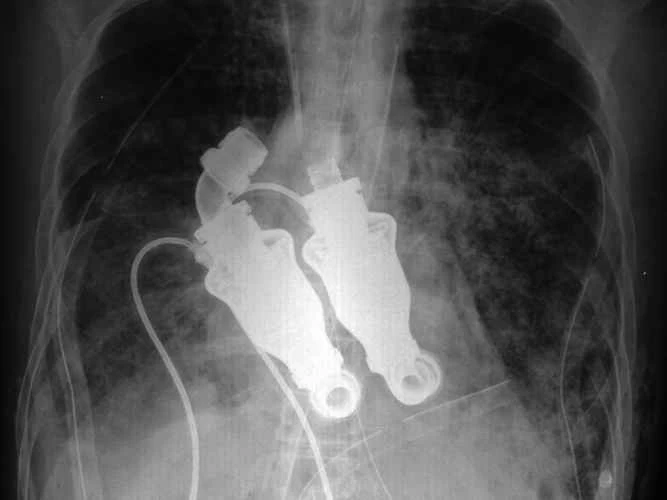 心臓:鼓動は不要