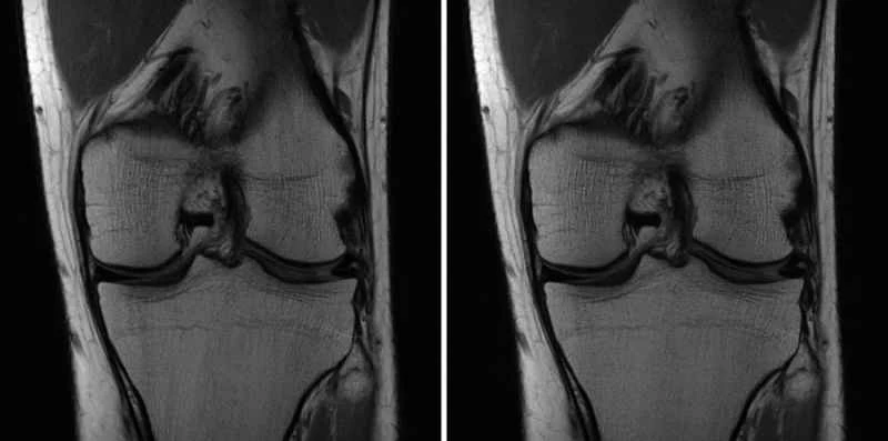 フェイスブックが人工知能を使ってMRIスキャンを高速化する取り組みを独占取材