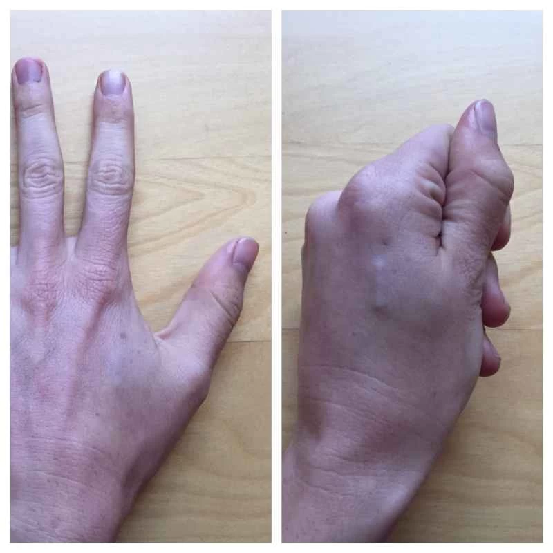 RFIDインプラント